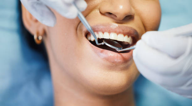 Teeth Whitening in IA