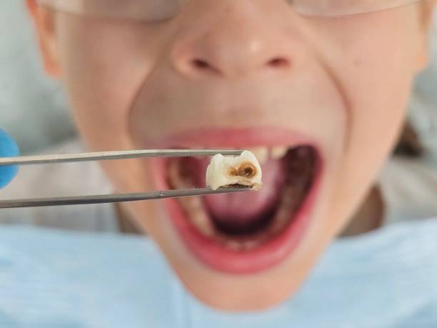 Best Chipped Tooth Repair Near Me  in Harlan, IA